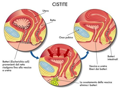 cistite