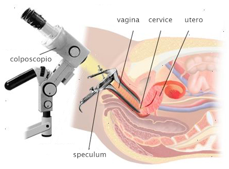 colposcopia