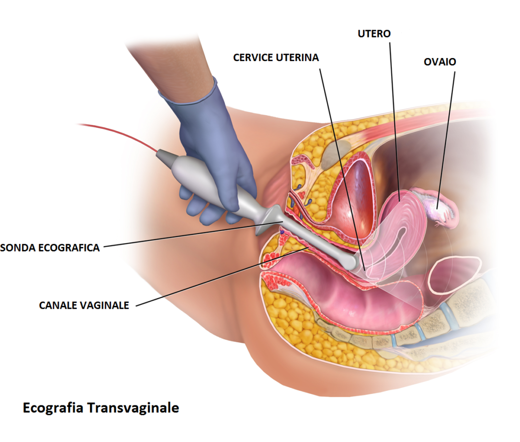 tumore collo utero