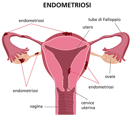 endometriosi